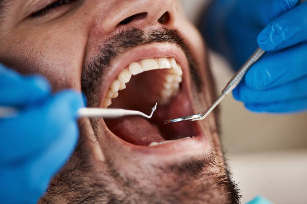 Best Emergency Dentist for Lost Fillings or Crowns in Auburn, IN